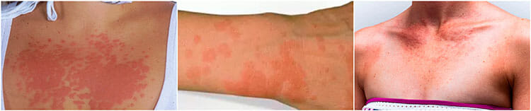 ¿Sabes cómo reconocer la alergia al sol?