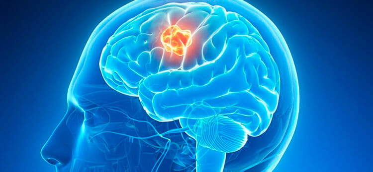 Tumor cerebral