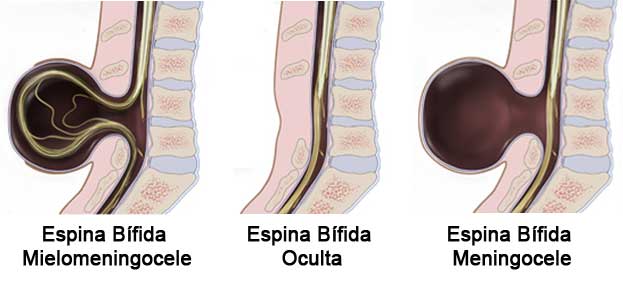 Tipos de espina bífida