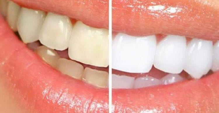 Manchas en los dientes: causas y tipos