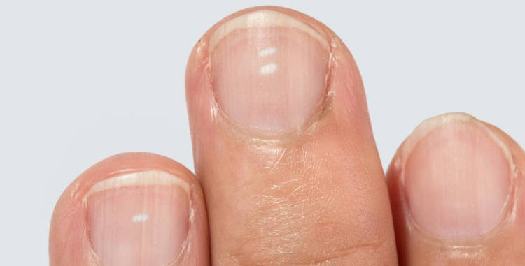 Manchas en las uñas