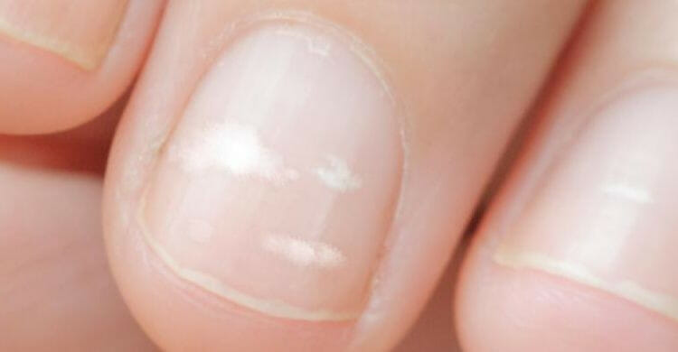 como quitar las manchas de las uñas de los pies