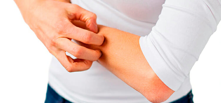 Dermatitis atópica