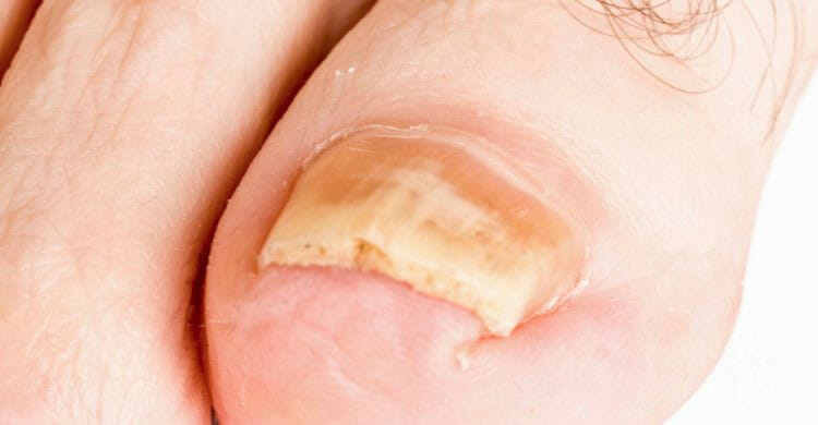 Síndrome de las uñas amarillas