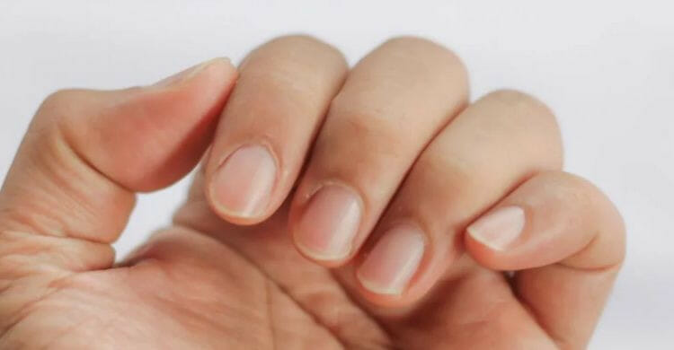 Uñas amarillas