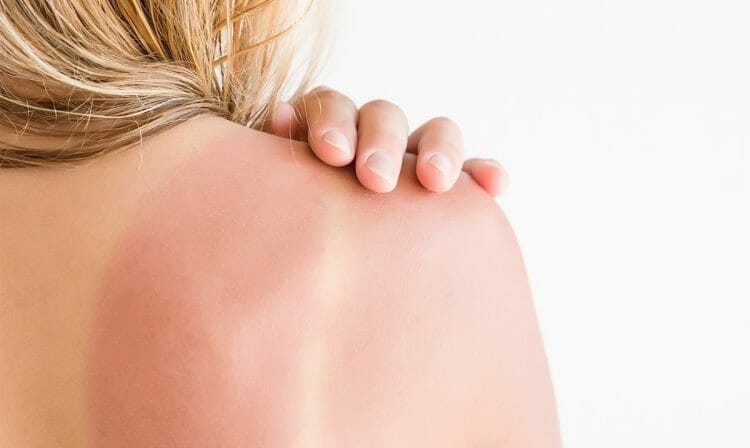Síntomas de la insolación y qué hacer para prevenirla
