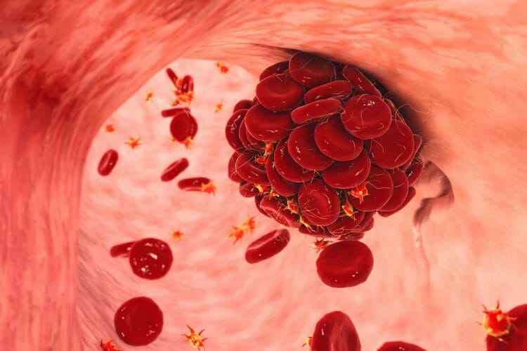 Fibrinógeno alto: causas, síntomas, tratamiento y prevención