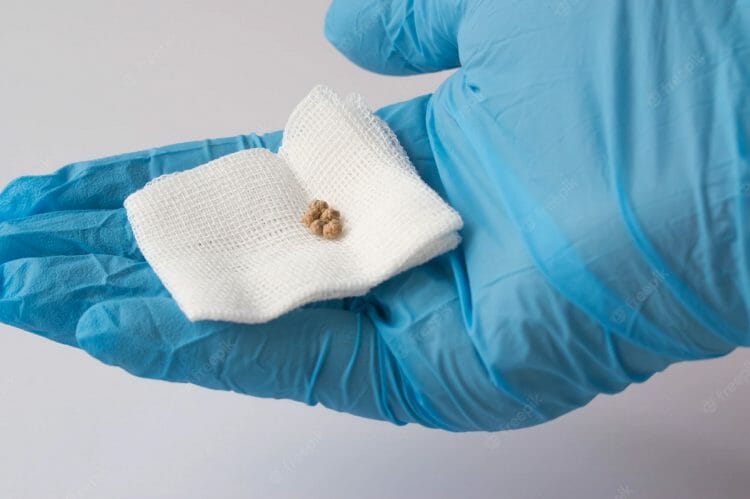 Piedras en la vesícula que son