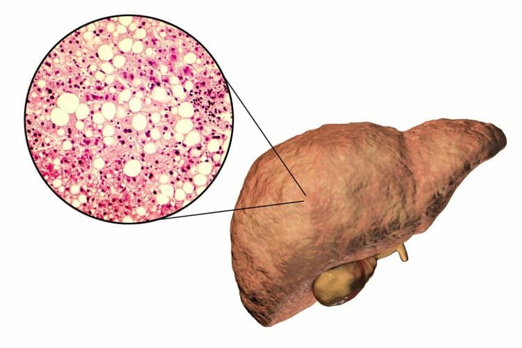 Diagnosticar enfermedad de wilson