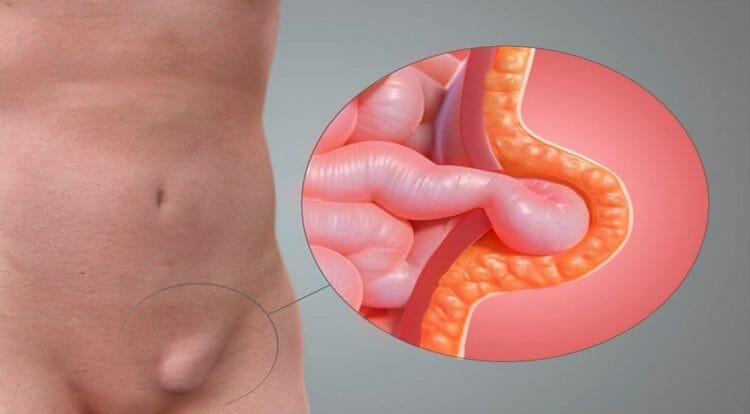 Qué es la Hernia inguinal
