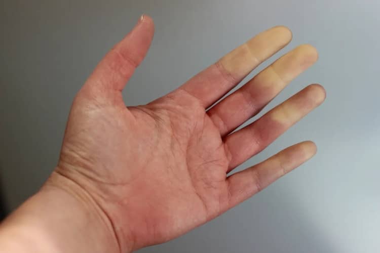 Fenómeno de Raynaud