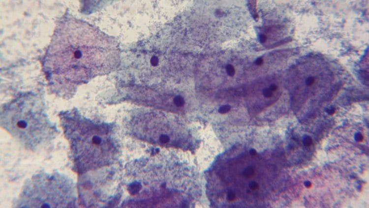 Vaginosis bacteriana