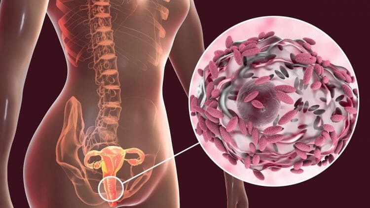 Vaginosis bacteriana: causas, síntomas y tratamiento