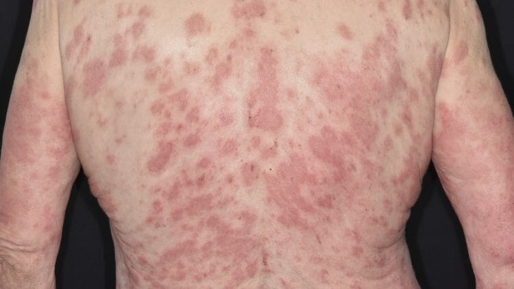 que es la dermatitis