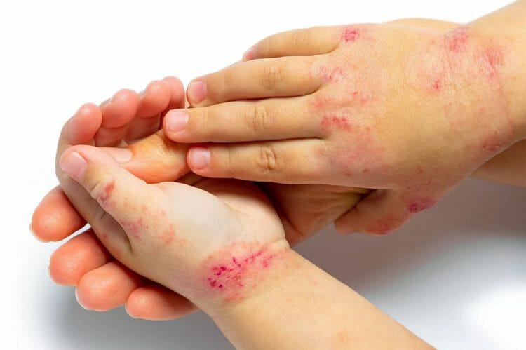 Dermatitis herpetiforme