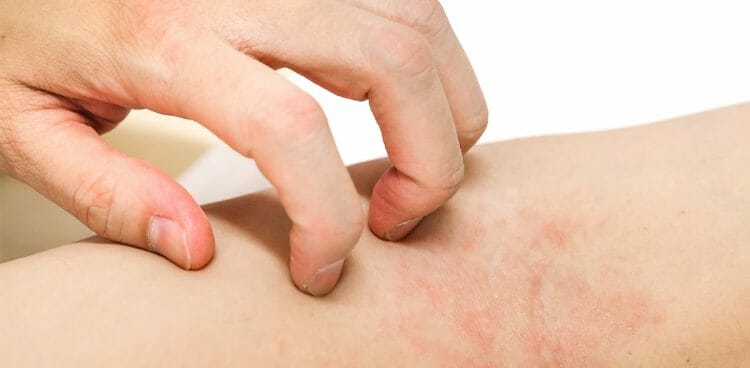 ¿Qué es la dermatitis? Los tipos que hay y características
