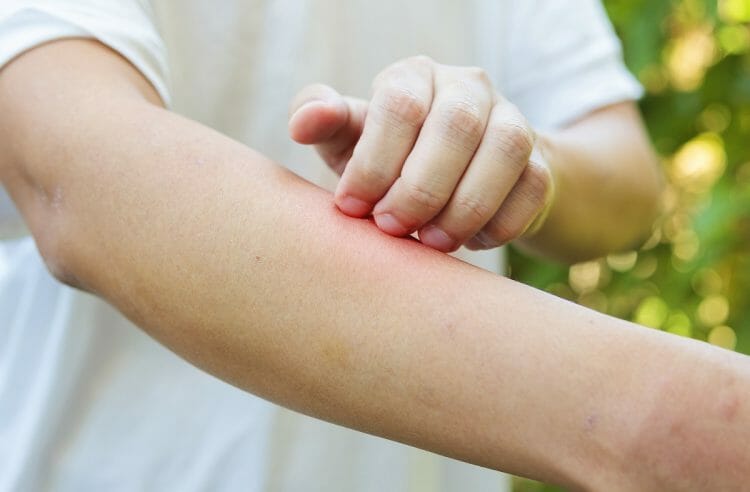Dermatitis seborreica