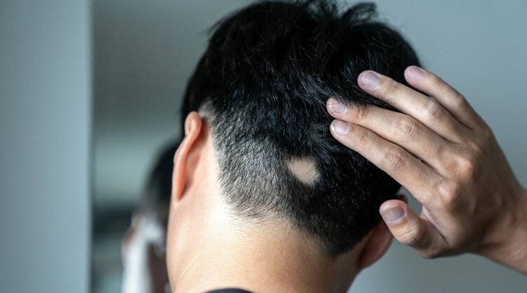 Qué es la alopecia areata, causas y tratamientos