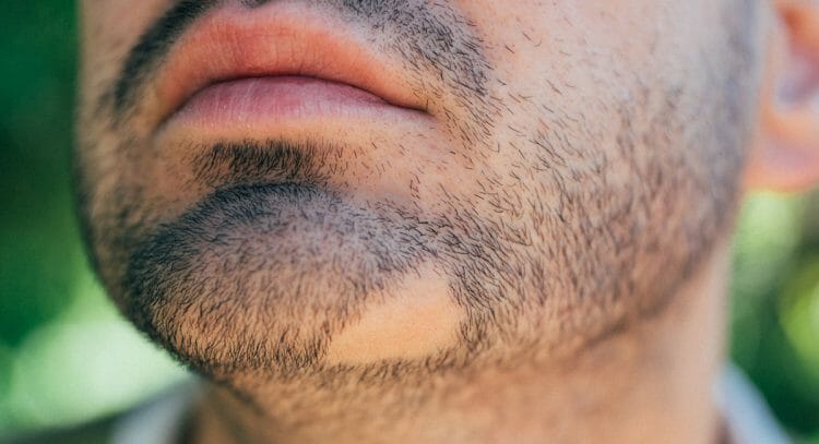 Tratamiento de alopecia areata