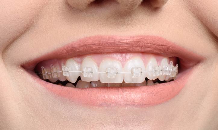 Brackets transparentes
