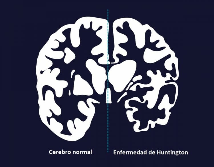 Tratamientos para enfermedad de Huntington