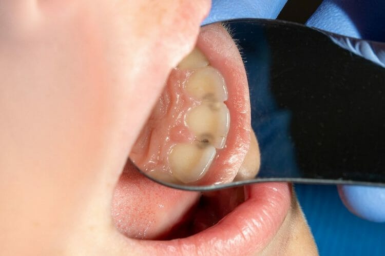 Tratar caries