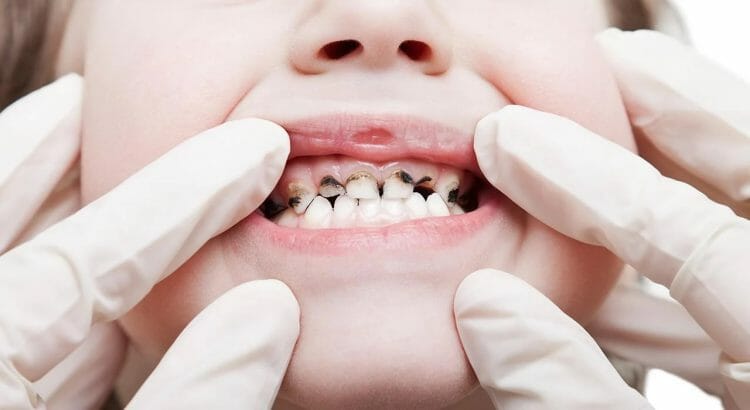 Qué son las caries