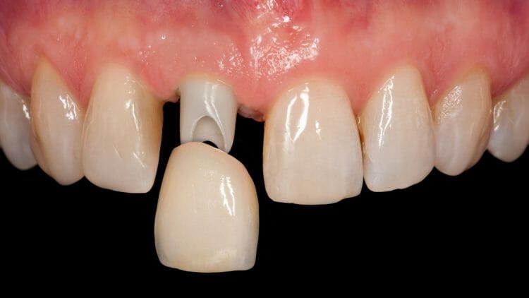 Qué son las Coronas dentales