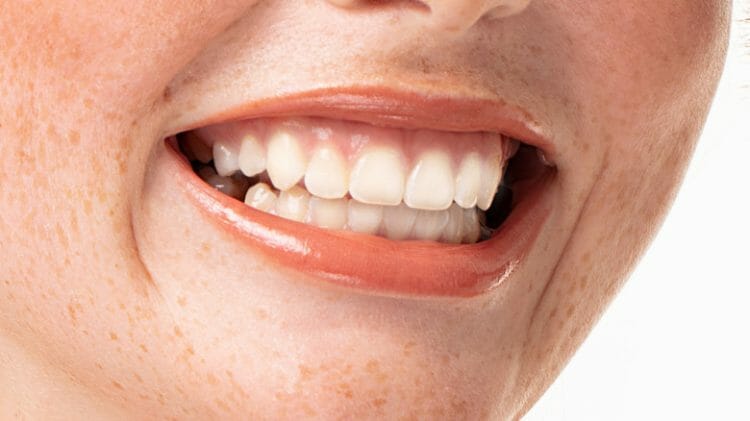 Encías blancas: causas y tratamiento
