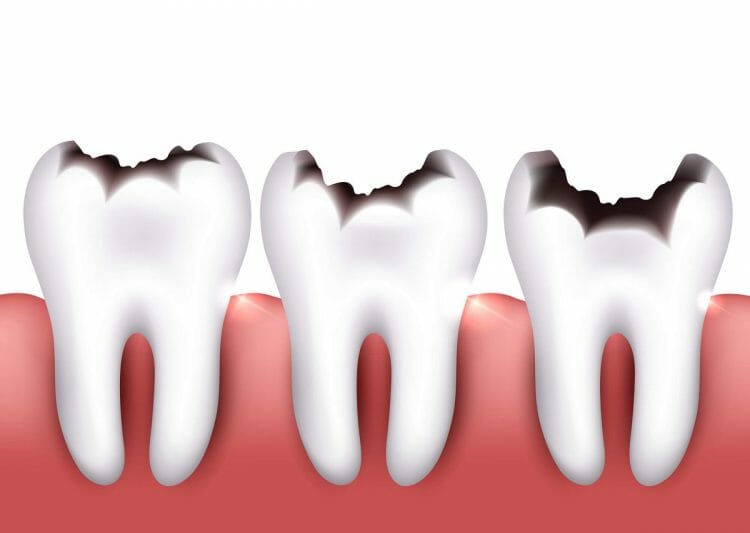 Muela con caries