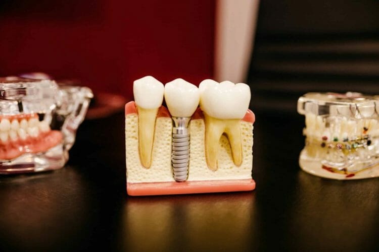 Para que sirven las coronas dentales