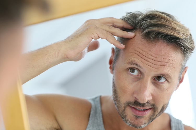 Alopecia androgénica y salud mental como causa y efecto