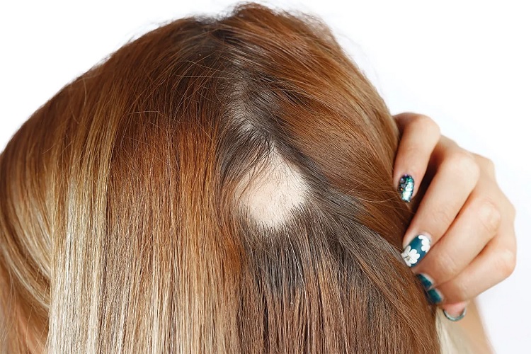 Alopecia androgénica