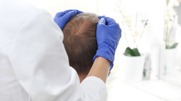 Diagnóstico de la alopecia