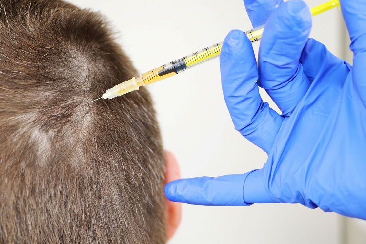 Tratamiento de la alopecia