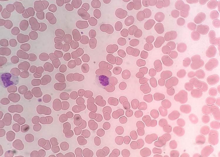 Linfocitopenia