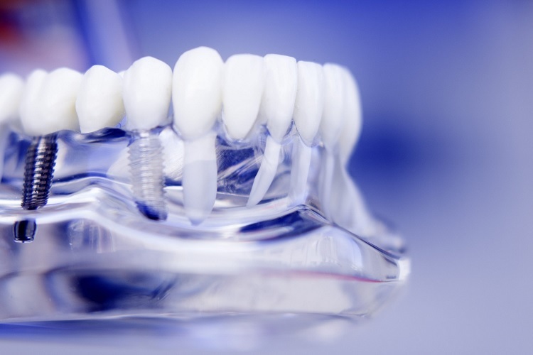 Implantes dentales