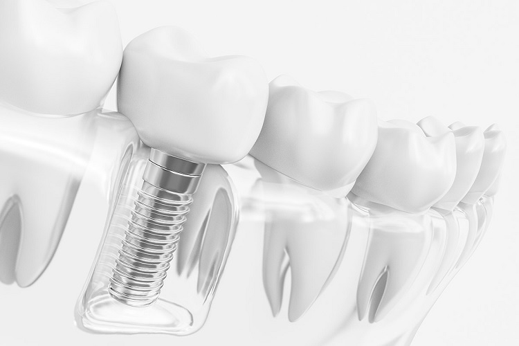 Tipos de implantes