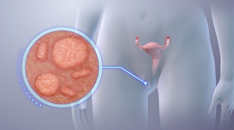 Herpes genital: qué es, síntomas y tratamiento