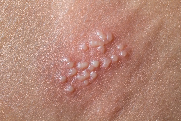 Herpes genital