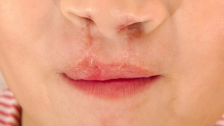 Tratamiento del labio leporino
