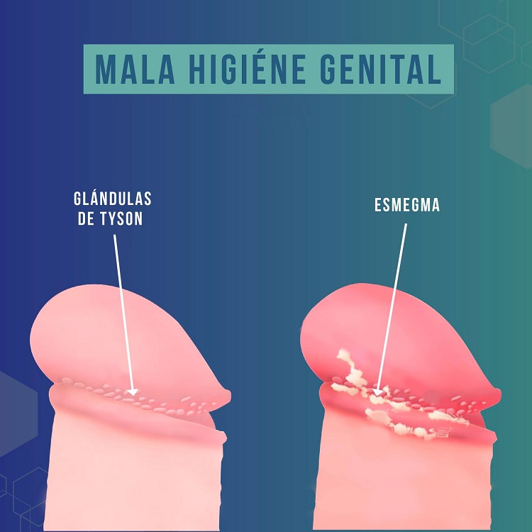 Causas del esmegma