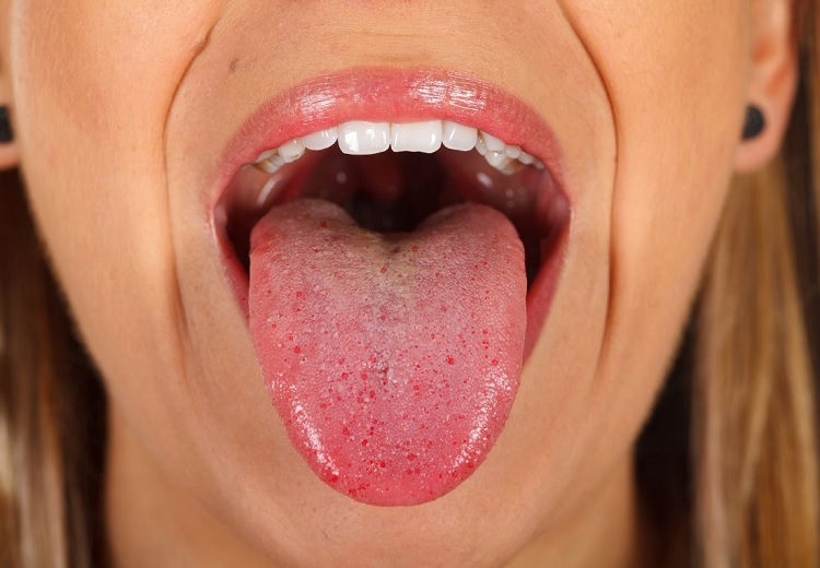 Granos en la lengua