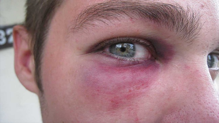 Hematoma