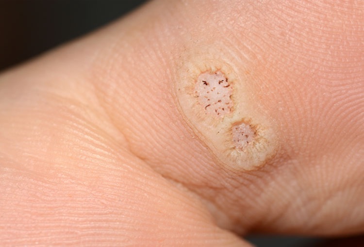 Verrugas plantares