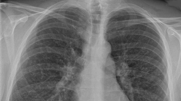 Agua en los pulmones