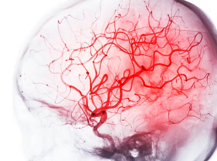 Angiografía cerebral: cómo se realiza y cuáles son sus riesgos