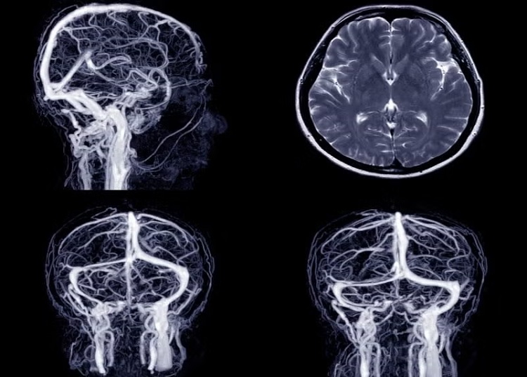 Angiografía cerebral