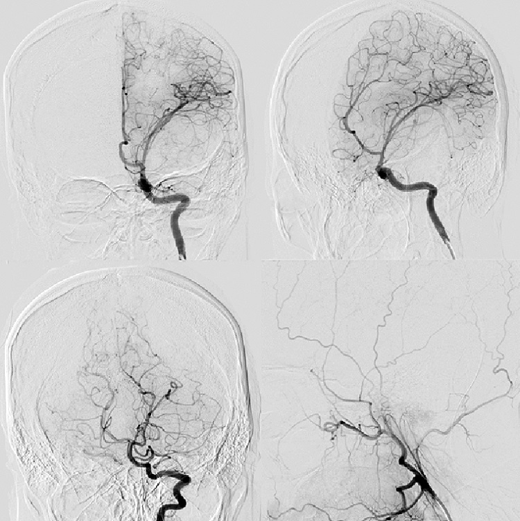 Angiograma cerebral