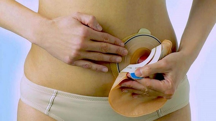 Ostomia